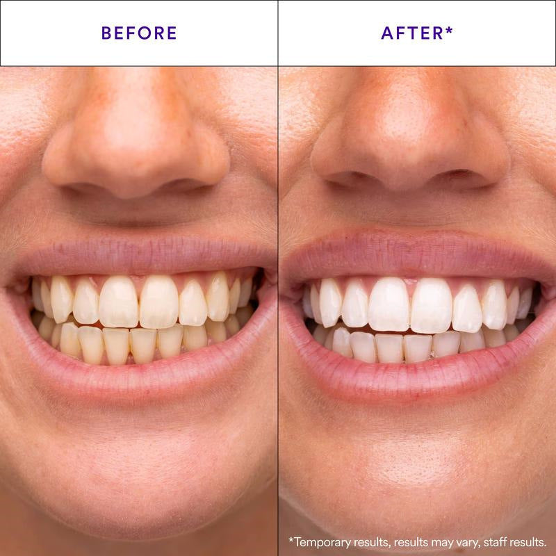 Daily teeth whitening strips, enamel-safe - detail photo 2