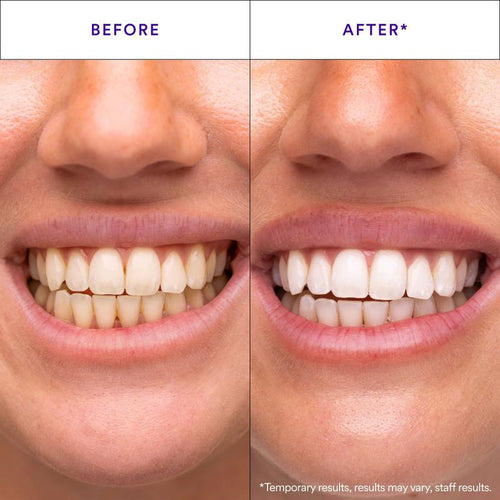 Daily teeth whitening strips, enamel-safe - detail photo 2